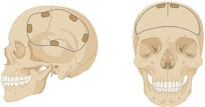 Immunopathogenesis of Craniotomy Infection and Niche-Specific Immune Responses to Biofilm